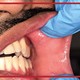 تشخیص زودهنگام شکست درمان ریشه؛ روش‌های کلینیکی و رادیوگرافی